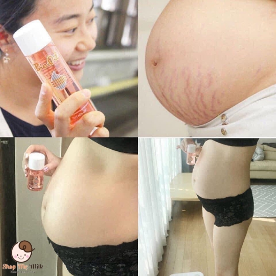 Dầu dưỡng giúp mờ sẹo & giảm rạn da Bio-Oil (125ml) Úc